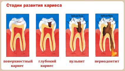 Периодонтит: воспаление тканей у корня зуба