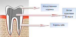 Восстановление зуба с помощью культевой вкладки